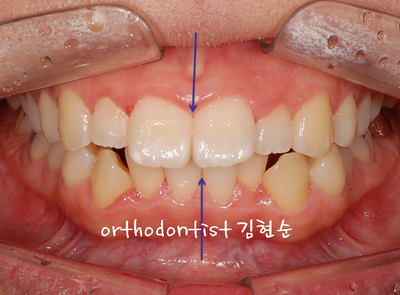 강남 돌출 관련 이미지 4