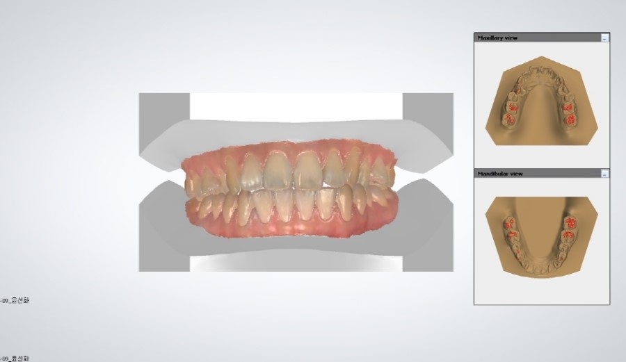 발치교정 부작용 옥니 해결법 관련 이미지 7