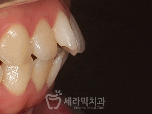 돌출입교정만 했을 뿐인데, 얼굴형과 무턱까지 개선된 치아교정전후 관련 이미지 5