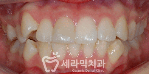 치열불규칙과 돌출입 치아교정전후 턱라인 변화! 관련 이미지 4