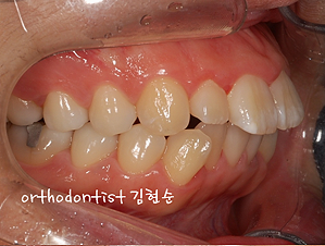 강남 돌출입 교정 관련 이미지 5