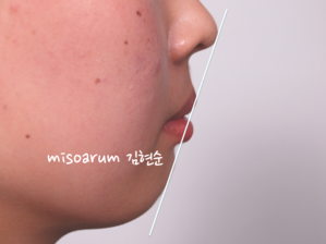 강남 돌출입 교정 관련 이미지 8