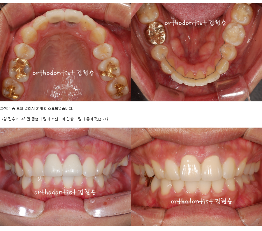 세라믹교정 세라믹치과-돌출입발치교정 1 관련 이미지 7