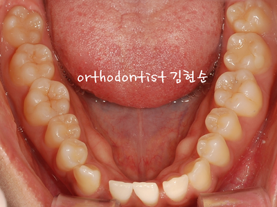 치열 교정 ( 벌어짐 ) 관련 이미지 8