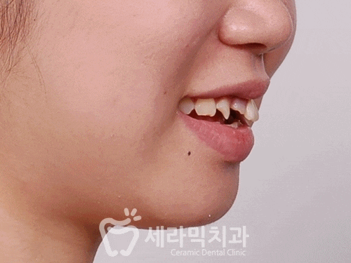 이빨교정 돌출입 토끼앞니 깨진앞니 치아교정 전후 관련 이미지 1