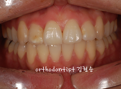 강남 돌출 관련 이미지 20