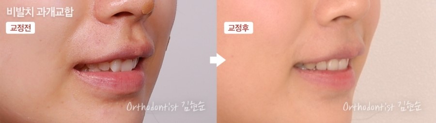 과개교합 무턱 개선 관련 이미지 12