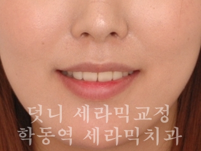 덧니교정 잘하는 학동역 교정치과, 세라믹치과 관련 이미지 7