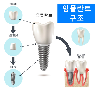임플란트 건강보험으로 씹는 즐거움을! 관련 이미지 5
