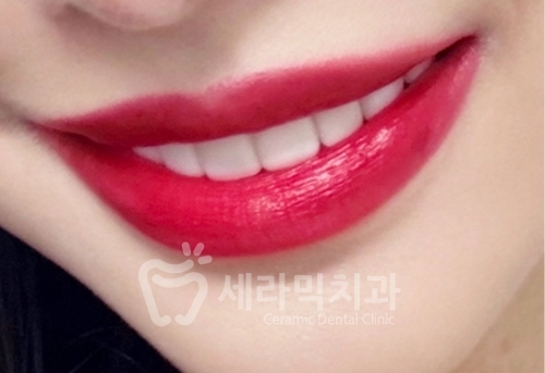 무삭제라미네이트 , 세라네이트가 궁금하다면? 관련 이미지 7