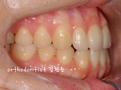 개방 교합 관련 이미지 29