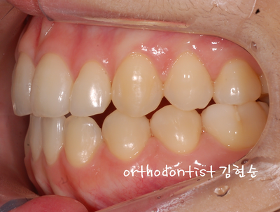 개방 교합 관련 이미지 30