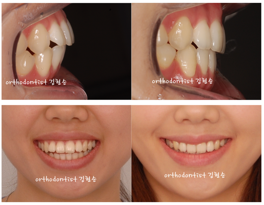 세라믹교정 세라믹치과-돌출입발치교정 6 관련 이미지 6