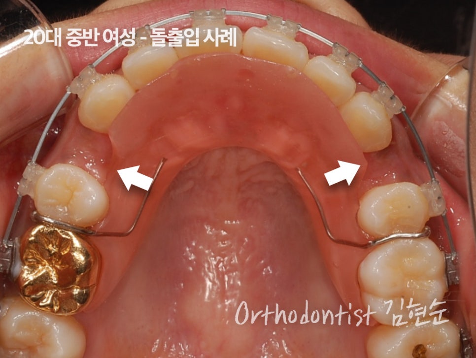 학동역치과 치아교정은 여기서 !! 관련 이미지 9