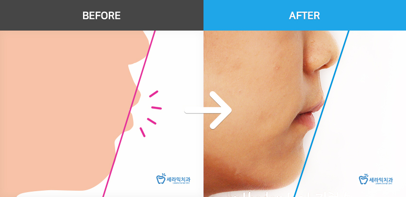 학동역치과 미국3M교정 추천 ~~ 관련 이미지 14