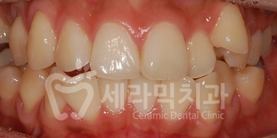 돌출입 덧니 비대칭 치아교정 전후 인상변화! 관련 이미지 5