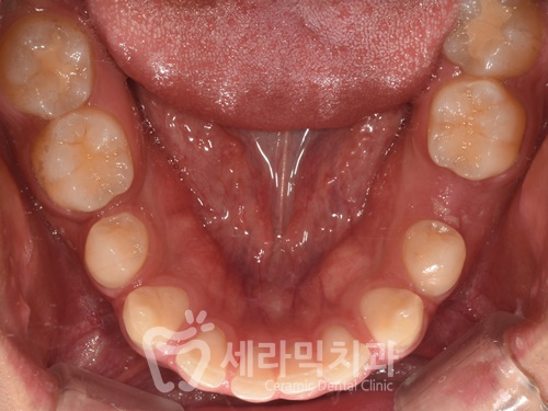과개교합, 거미스마일, 치아 벌어짐까지 한번에! 치아교정전후 살펴보기 관련 이미지 3