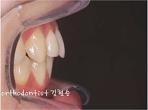 강남 돌출입 교정 관련 이미지 4