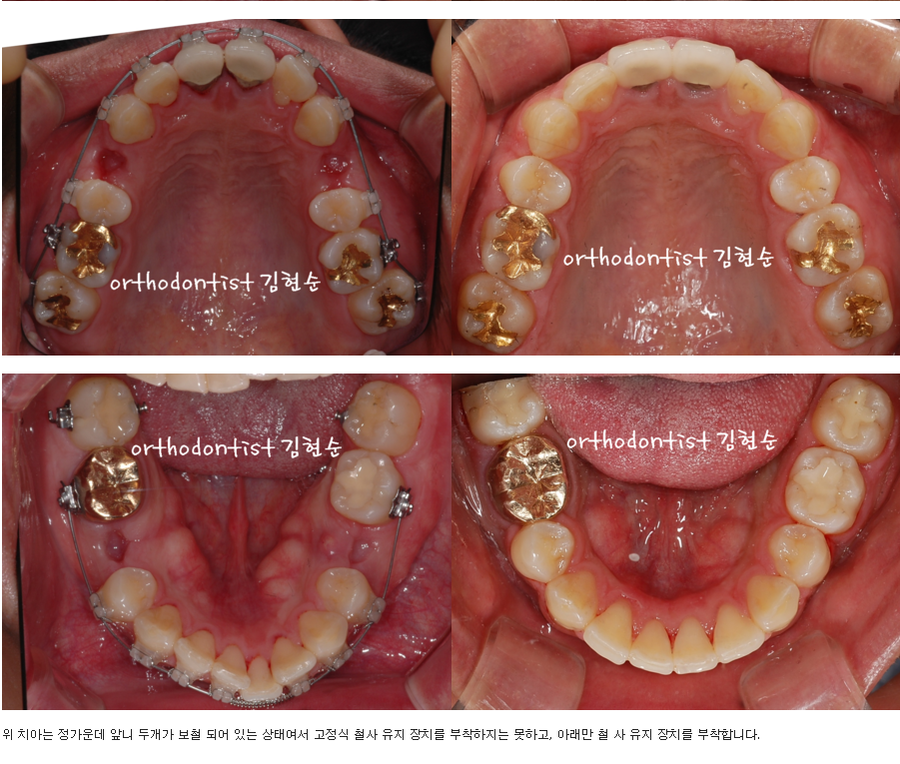 세라믹교정 세라믹치과-돌출입발치교정 1 관련 이미지 6