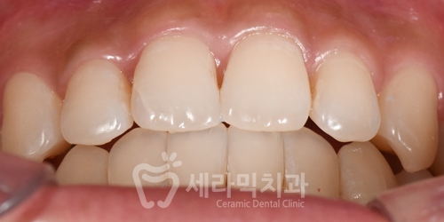 Open Bite Dental Clinic Orthodontic Before and After: Did a Long-Looking Jaw Become Shorter? image 1