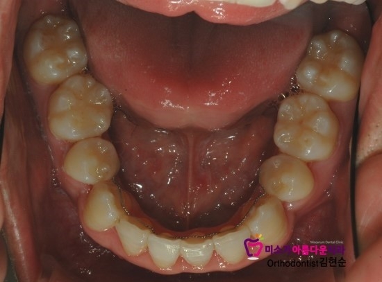 학동역치아교정잘하는치과 미소가아름다운치과 덧니교정 과정 관련 이미지 7
