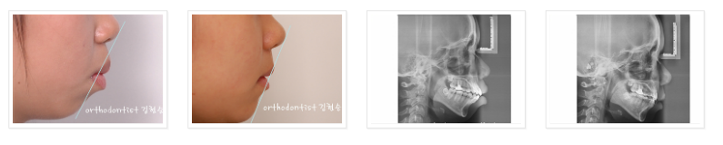 미니스크류를 이용한 발치 돌출입 교정, 무턱 개선 관련 이미지 10