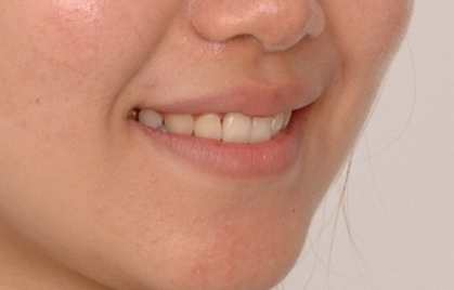 강남 돌출입 교정 관련 이미지 24