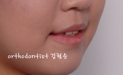 치열 교정(치열 불규칙) 관련 이미지 5