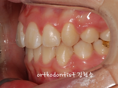 강남 돌출 (토끼 치아) 관련 이미지 30