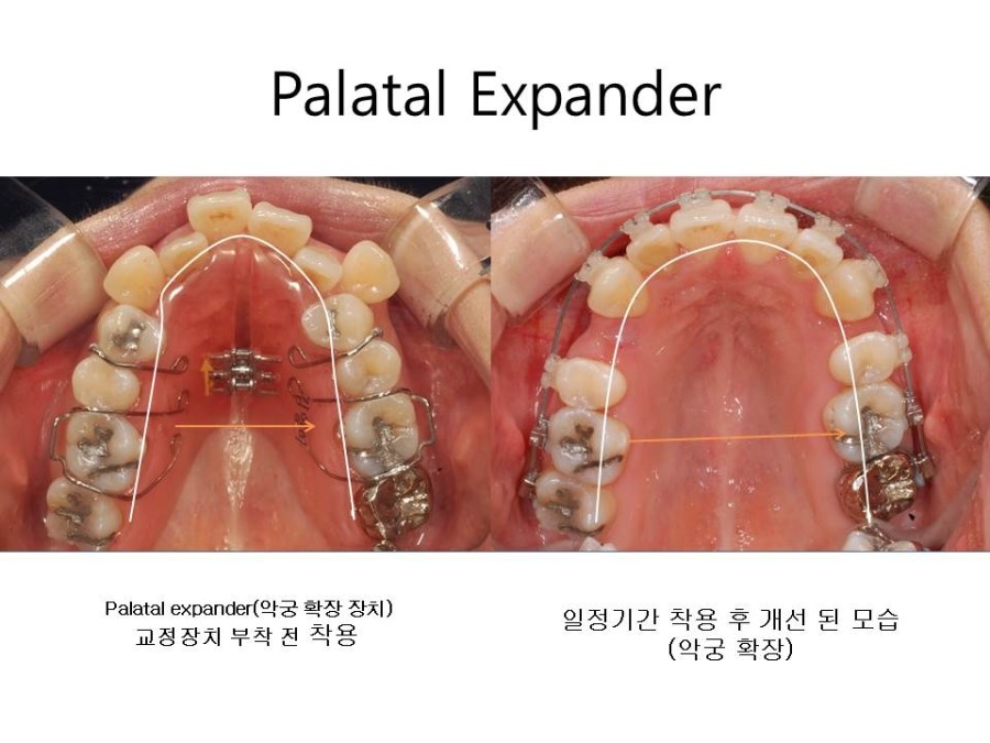 학동역치과 치아교정 잘하는 곳 ! 관련 이미지 23
