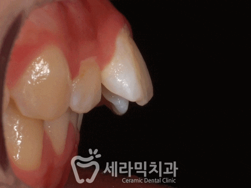 돌출입과 치열불규칙 치아교정 전후 : 자신감 넘치는 미소! 관련 이미지 1