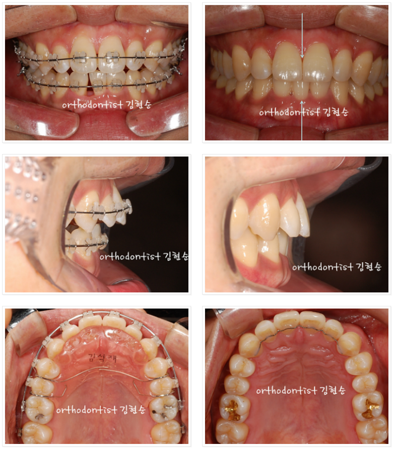 들쑥날쑥한 아래 앞니, 발치 후 교정 관련 이미지 3