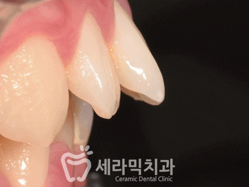 과개교합과 돌출입 개선으로 달라진 인상, 세라믹치과 치아교정전후! 관련 이미지 12