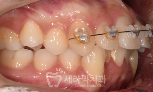 Before and After Orthodontic Treatment for Protruding Mouth and Deep Bite: A Calmer, More Sophisticated Transformation! image 8