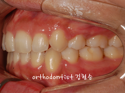 강남 돌출 관련 이미지 27