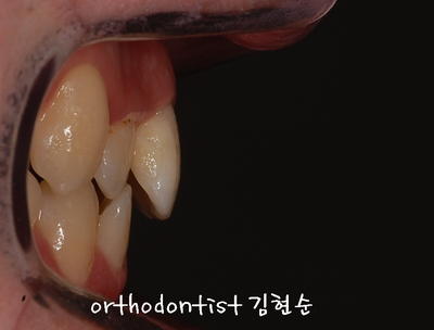 반대교합 관련 이미지 4