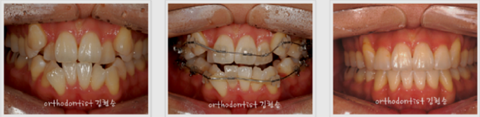 강남 덧니 관련 이미지 12
