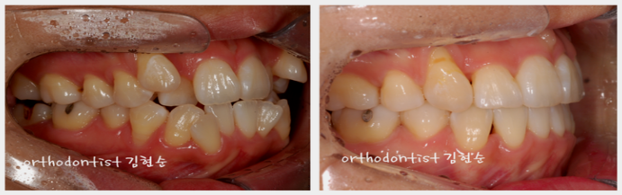 강남 덧니 관련 이미지 14