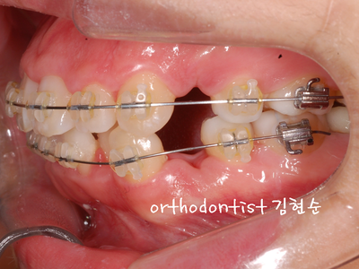 강남 돌출 관련 이미지 23