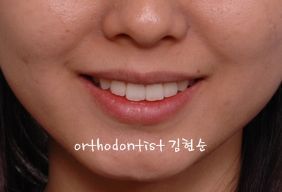 돌출 교정 (비발치 교정/비대칭) 관련 이미지 10