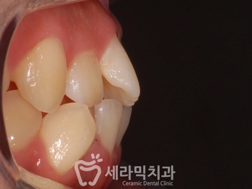 돌출입교정으로 갸름한 턱라인까지 되찾다! 돌출입 치아교정전후 관련 이미지 3