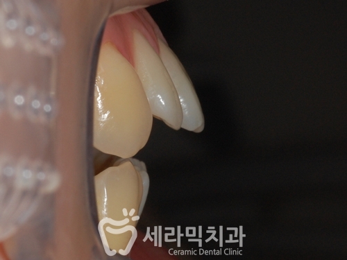 돌출입과 개방교합, 치아교정전후 자신감 UP! 치아건강 UP! 관련 이미지 1