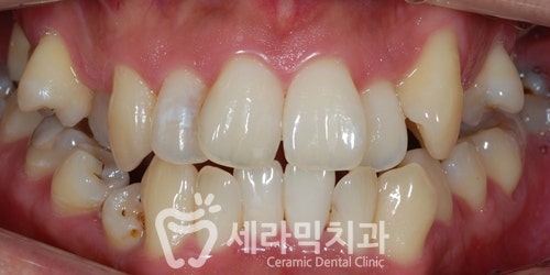 삐뚤빼뚤 틀어지고 불규칙한 치아배열 치아교정전후 관련 이미지 1