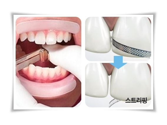 앞니투명교정  6개월이면 ok ! 관련 이미지 5
