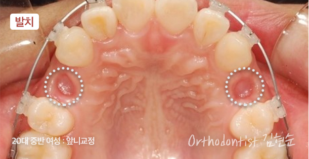 강남치아교정 브라켓비교분석 관련 이미지 19