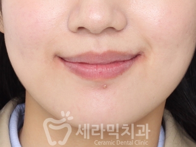 앞니 돌출, 나비치아를 남몰래 해결한 치아교정 전후! 관련 이미지 17