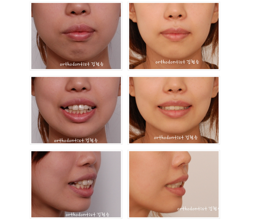 돌출입 발치교정, 미니스크류를 통한 6가지 변화 관련 이미지 10