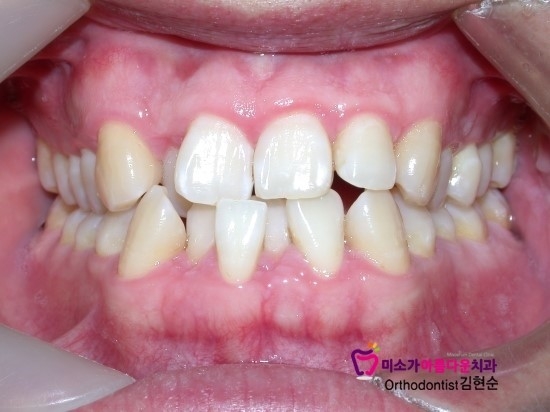 학동역치아교정잘하는치과 미소가아름다운치과 덧니교정 과정 관련 이미지 2