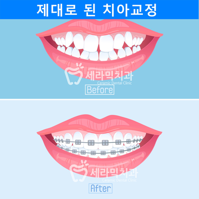 투명치아교정 부작용과 부실 진료? 관련 이미지 2