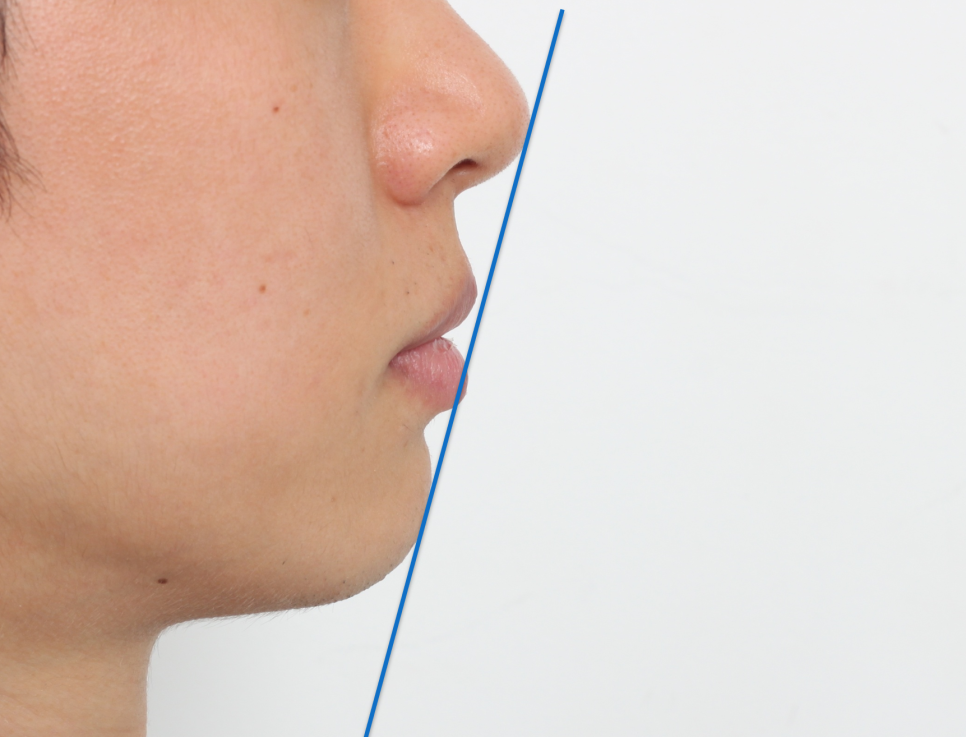 돌출입 재교정, 그것도 세 번째. 관련 이미지 3